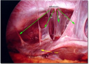 Pelvic Cavity Adhesions